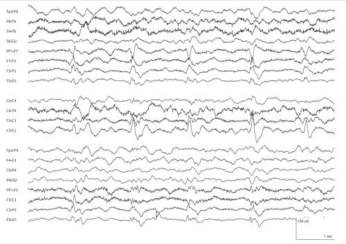 07-55.b.Periodic-Lateralized-Epileptiform-Discharges
