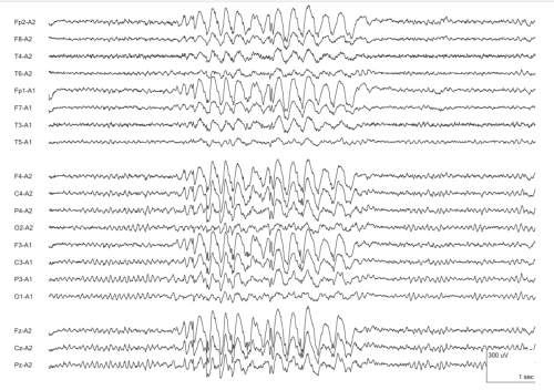 20-43.b.Generalized-Interictal-Epileptiform-Discharge