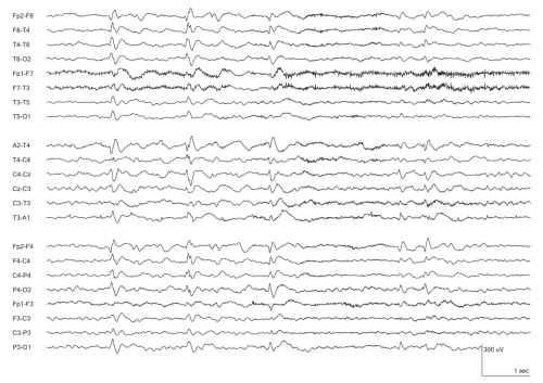 38.b.Temporal-Interictal-Epileptiform-Discharges