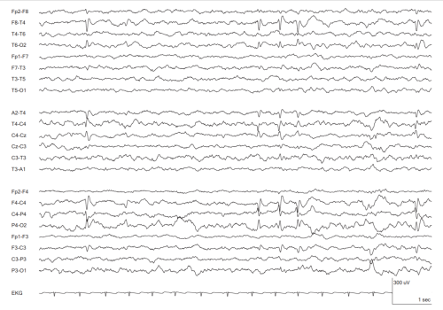 40.a.Rolandic-Interictal-Epileptiform-Discharges