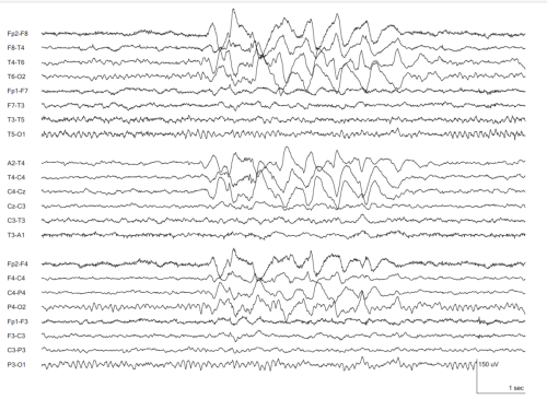41.a.Broad-Interictal-Epileptiform-Discharges-with-Prominent-Slow-Waves