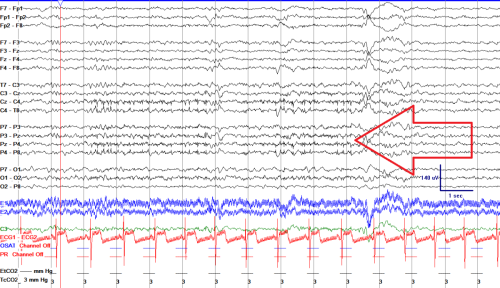 42.a.E-Focal-onset-seizure-focalszcorrelate