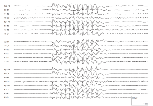 43.d.Generalized-Interictal-Epileptiform-Discharge