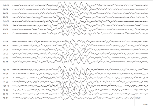 45.a.-Slow-Spike-and-Slow-Wave-Interictal-Epileptiform-Discharges