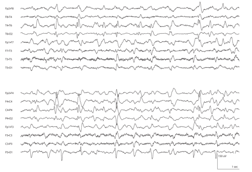 58.a.Bilateral-Independent-Periodic-Lateralized-Epileptiform-Discharges