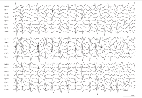 58.b.Bilateral-Periodic-Epileptiform-Discharges