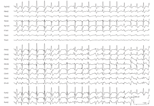 Bilateral-Periodic-Epileptiform-Discharges