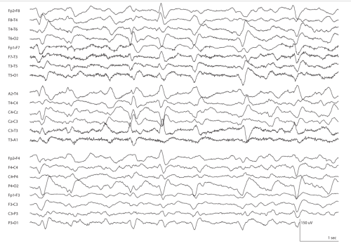 BIPD - Bilateral-Periodic-Epileptiform-Discharges